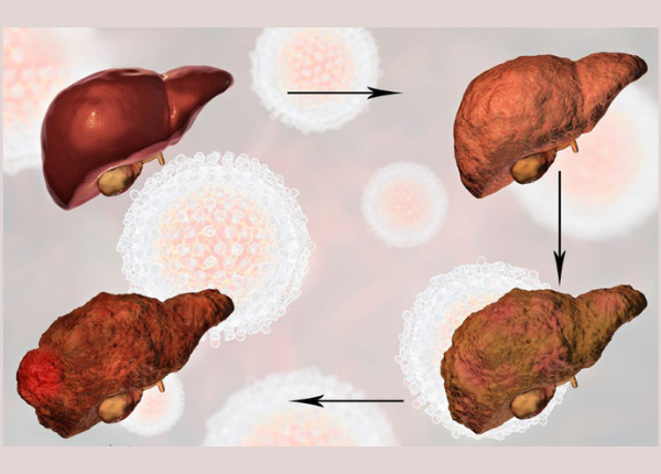 Xơ gan là bệnh gì? Có nguy hiểm không?