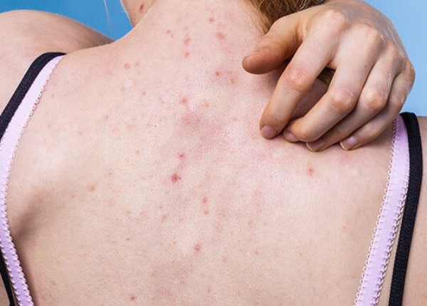 Nổi mụn lưng: Dấu hiệu và biện pháp cải thiện