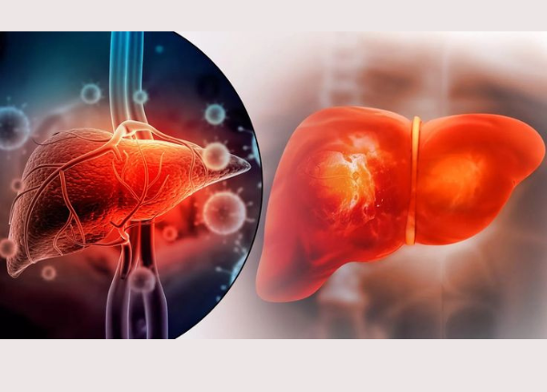 Xơ gan do rượu có chữa khỏi hoàn toàn được không?