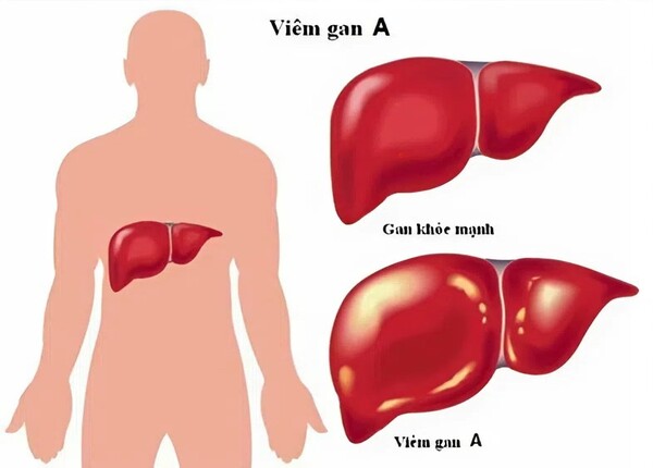 Bệnh gan có lây không và lây qua đường nào?