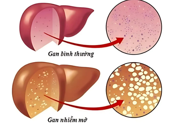 Phân biệt gan nhiễm mỡ không do rượu và gan nhiễm mỡ do rượu? 